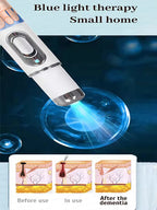 Quick and painless removal of warts, the latest generation blue light laser pen, hot-selling package - Path to Self-Improvement