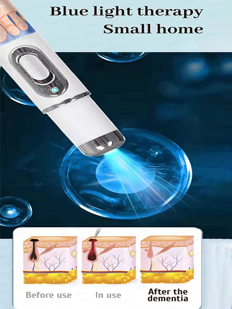Quick and painless removal of warts, the latest generation blue light laser pen, hot-selling package - Path to Self-Improvement