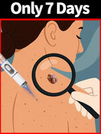 Quick and painless removal of warts, the latest generation blue light laser pen, hot-selling package - Path to Self-Improvement