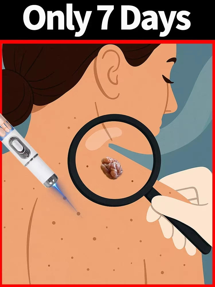 Quick and painless removal of warts, the latest generation blue light laser pen, hot-selling package - Path to Self-Improvement